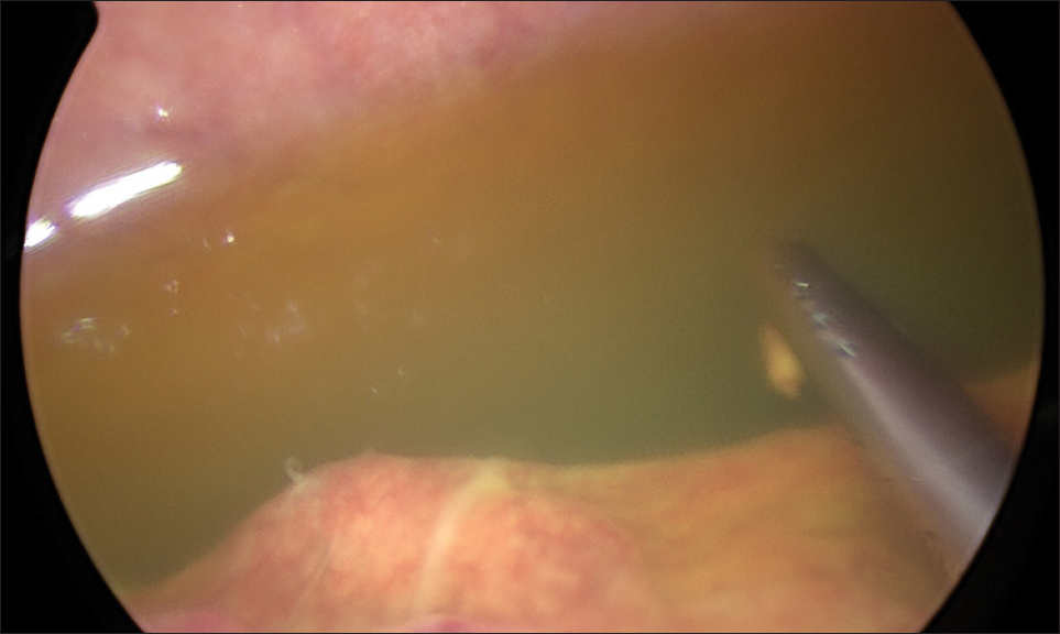 Intraoperative image of ascetic fluid.